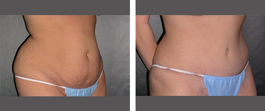 Liposuction Procedure in Plano TX - Fat Reduction Treatment